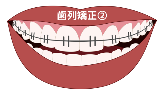 歯列矯正②